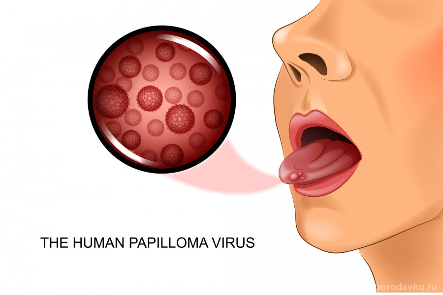 oropharyngeal human papillomavirus hpv)